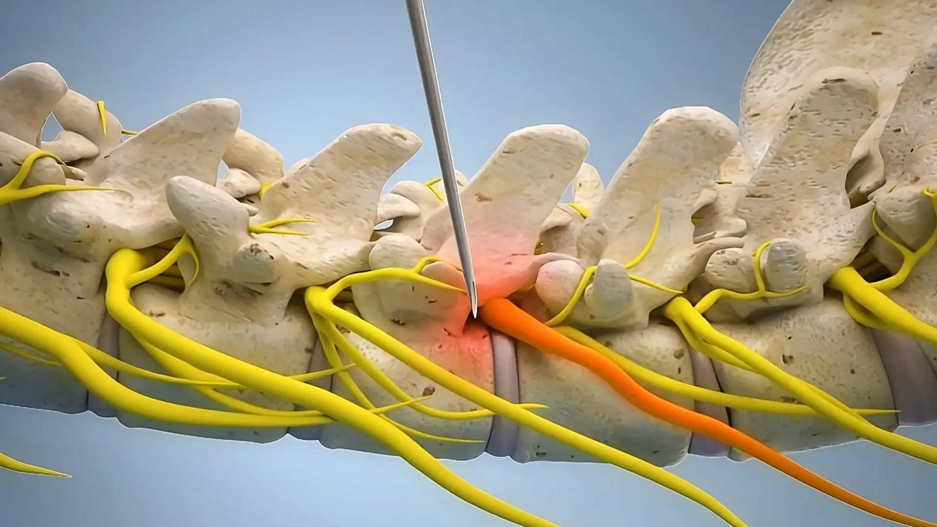 Representação de como a rizotomia atua